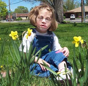 Patau Syndrome Patau (12).jpg